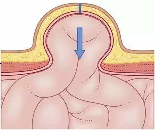 成人疝气的恢复方法视频,视频教程详解