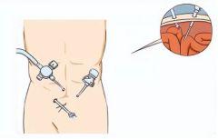 成人疝气的恢复方法视频,视频教程详解
