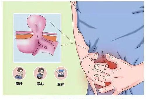成人疝气的恢复方法视频,视频教程详解