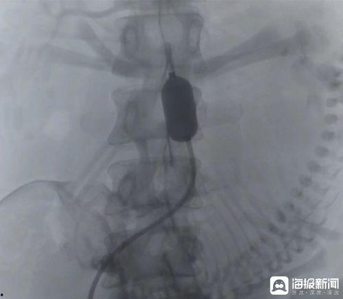 成人股动脉穿刺点定位视频,视频教学解析