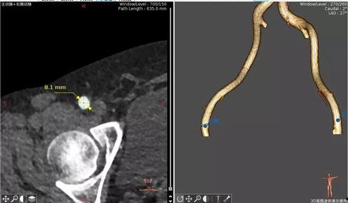 成人股动脉穿刺点定位视频,视频教学解析