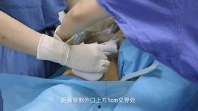 成人股动脉穿刺点定位视频,视频教学解析